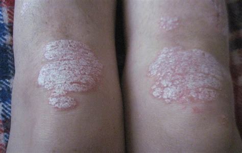 Plaque Psoriasis On Knees Pictures Symptoms And Pictures