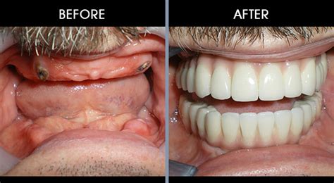 Dental Implants Nyc Dental News Network