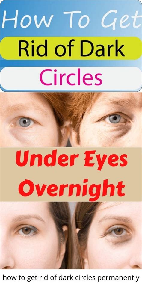 How do you treat closed comedones? how to get rid of dark circles under eyes overnight ...