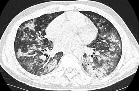 Shows A Chest Ct Scan Of The Patient Indicating Severe Interstitial