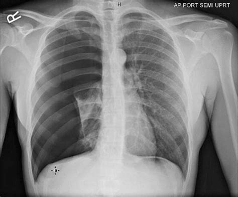 Pneumothorax Aka Collapsed Lung My Xxx Hot Girl