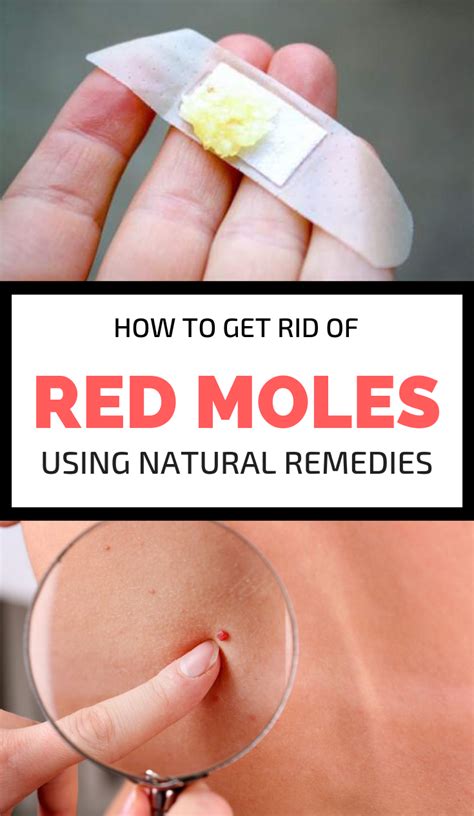 How To Get Rid Of Red Moles Using Natural Remedies