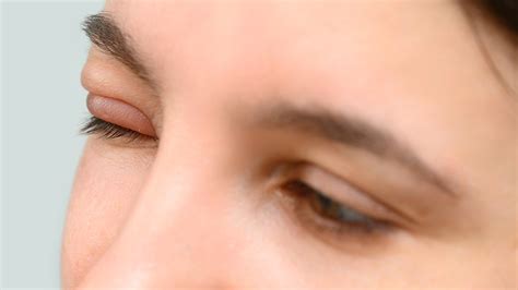 When To See A Doctor About Your Swollen Eyelid