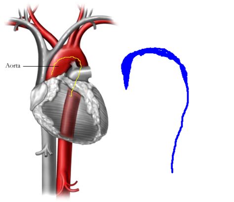 doctor told     uncoiled aorta cardiac health