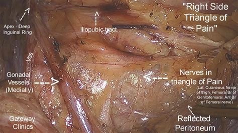 Inguinal Hernia Surgery Anatomy