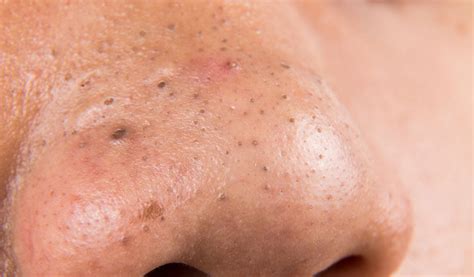 Comedonal Acne Signs And How To Treat And Tiege Hanley