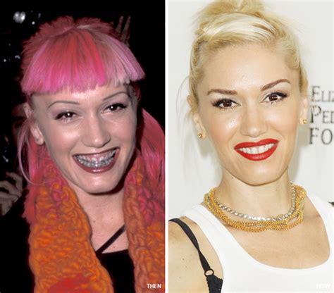 Smile Makeover Gwen Stefanis Transformation Newbeauty