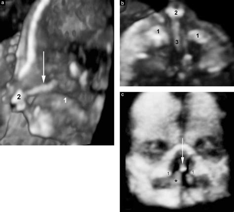 Two‐ And Three‐dimensional Sonographic Assessment Of The Fetal Face 2