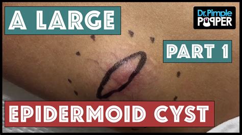 An Extra Elbow A Floatation Device Or An Epidermoid Cyst Part 1 Of
