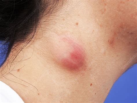 Sebaceous Cyst Stock Image C Science Photo Library