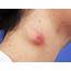 Sebaceous Cyst  Stock Image C025/4612 Science Photo Library