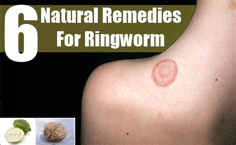 6 Proven Natural Remedies For Ringworm How To Treat Ringworm