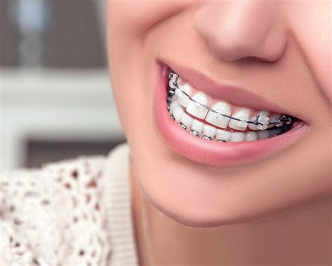 How Cosmetic Braces Can Give You The Beautifully Aligned Smile Youve