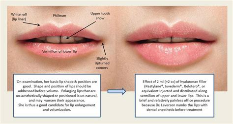 Type Of Lip Fillers Your Complete Guide To Juvéderm® And Restylane®