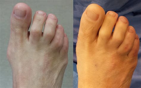 How To Fix Hammer Toes Without Surgery Serious Pain After Hammertoe