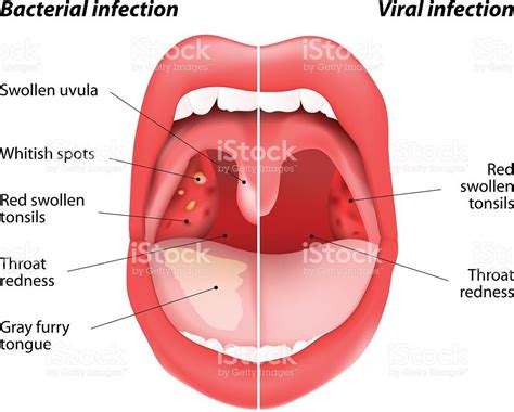 Related Image Swollen Uvula Tonsils Adenoids Viral Infection