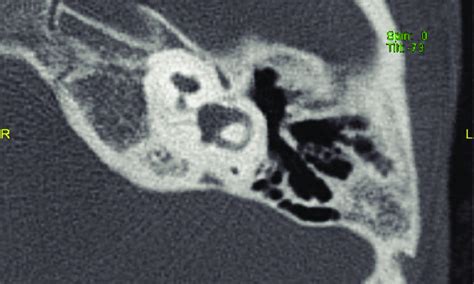 Axial Computed Tomography Of Left Cochlear Hypoplasia Type Iii Note