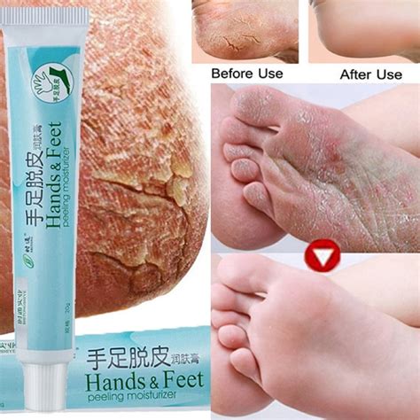 Kokovifyves Cracked Heel Balm Cream For Rough Dry And Cracked Chapped Feet Heel Skin