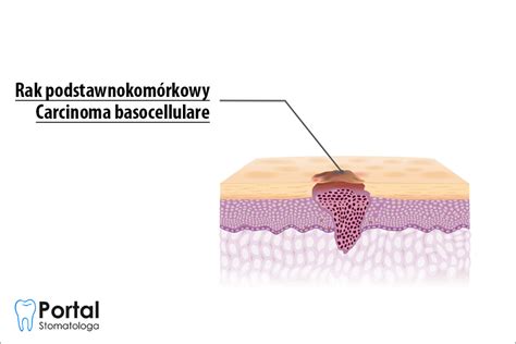 Carcinoma Basocellulare Portal Stomatologa