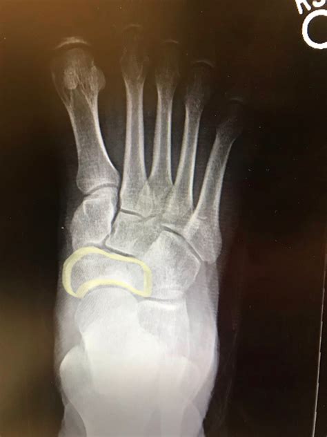 Figure Navicular Bone Right Foot Radiograph Statpearls Ncbi