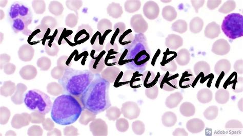 Chronic Myeloid Leukemia Cml Peripheral Blood Smear Hematopathology