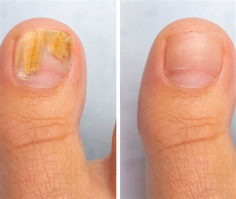 Laser Fungal Nail Treatment Laserlife Clinic London