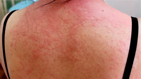 What Are The Most Common Types Of Rashes Ur Health Info