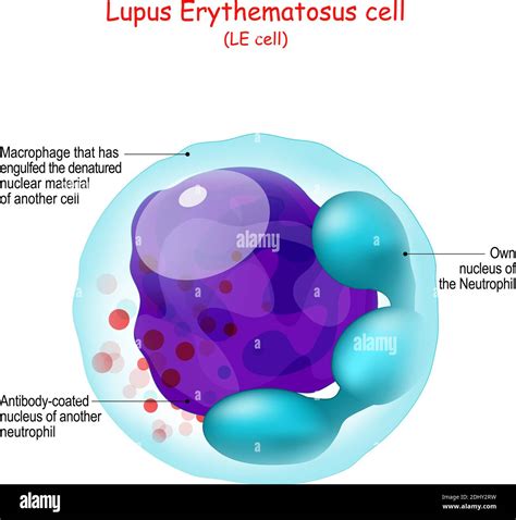 Lupus Eritematoso Estructura De La Célula Le Anatomía Humana Primer