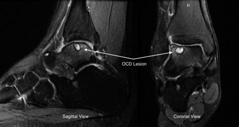 Osteochondral Defect Of The Talus Sports Medicine Review
