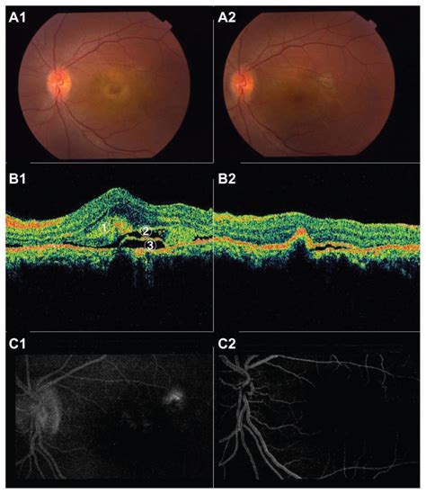 Case 1 Color Fundus Photography Shows Serous Detachment And Yellowish