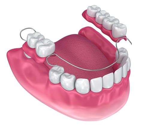 Astoria Dentist Looks At When Your Smile Needs A Partial Astoria Ny