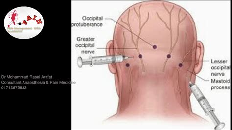 Greater Occipital Nerveblock Greateroccipitalnerveheadache
