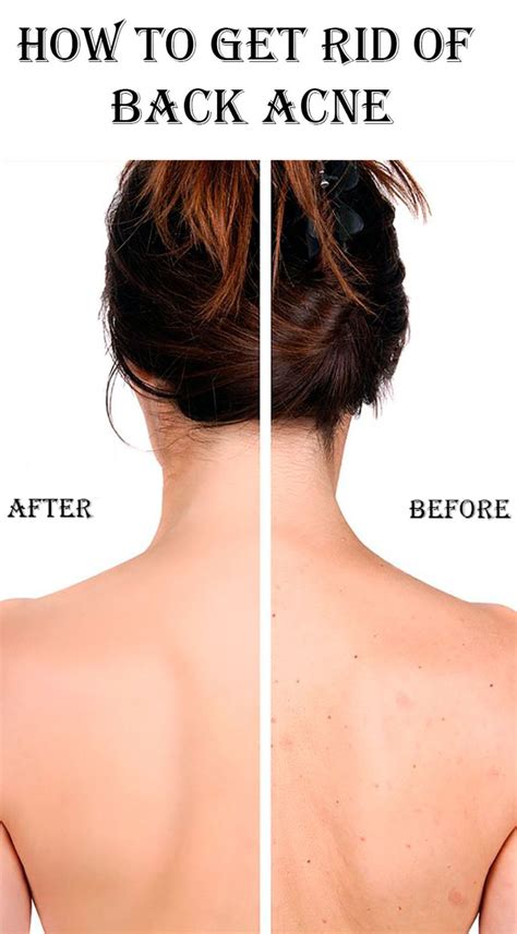 How To Get Rid Of Back Acne Stylish Belles Back Acne Treatment