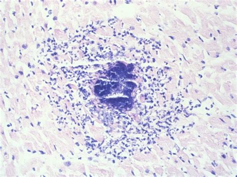 From animal models of cardiac inflammation we have detailed insight of the strain specific immune. MBBS Medicine (Humanity First): Myocarditis Etiology