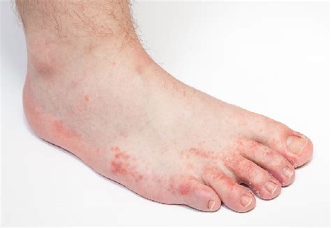 Fungal Foot Infections Werkman Boven And Associates