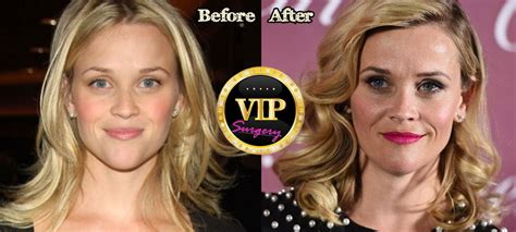 Reese Witherspoon Plastic Surgery Surgery VIP