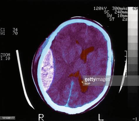 Brain Blood Flow Photos And Premium High Res Pictures Getty Images