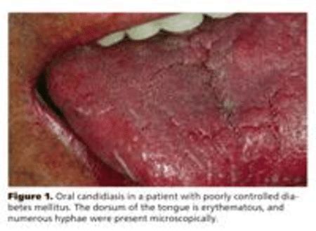 Oral Candidiasis In A Patient With Poorly Controlled Diabetes Mellitus Download Scientific