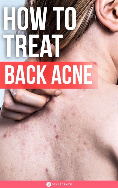 How To Get Rid Of Back Acne Using Home Remedies Artofit