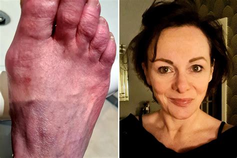 Long Covid Sufferer 53 Shares Horrific Picture Of Hands And Feet