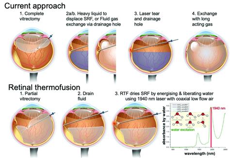 A Novel Method For Retinal Detachment Repair Aprof Wilson Heriot