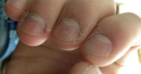 Man Nearly Dies After Getting Sick From Biting His Nails