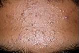Sandpaper Acne Treatment Images