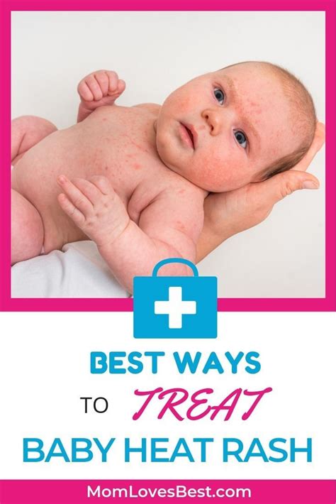 4 Best Ways To Treat Baby Heat Rash Riset