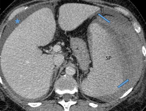 Nonoperative Management Of Spontaneous Splenic Rupture In A Patient