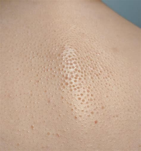 Maybe you would like to learn more about one of these? Boils on Back Causes, Symptoms, Large, in Babies ...