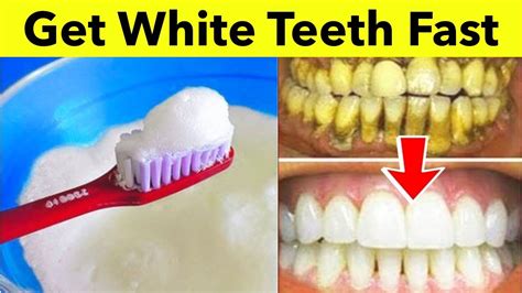 Best Way To Get White Teeth Fast In Just 1 Minute Diy Remedies For