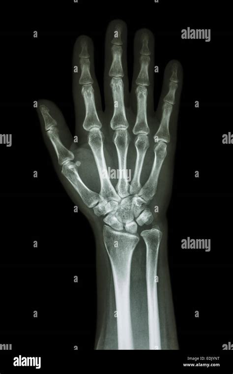 X Ray Hand And Forearm Ap Anterior Posterior Front View Stock Photo