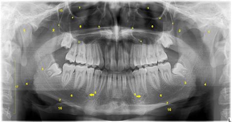 Radiografias Panorâmicas Definições E Indicações Papaiz Diagnósticos Odontológicos Por Imagem