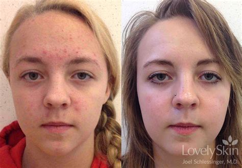 Acne Doctor Omaha Dermatologist Skin Specialists Pc